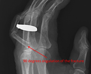 angulated fracture preop