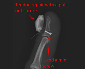 avulsion fracture