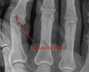 condylar-preop