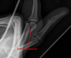 displaced fracture