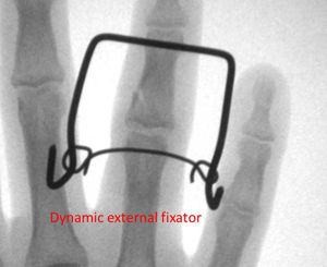 Dynamic External Fixator