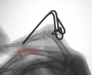 angulated fracture preop
