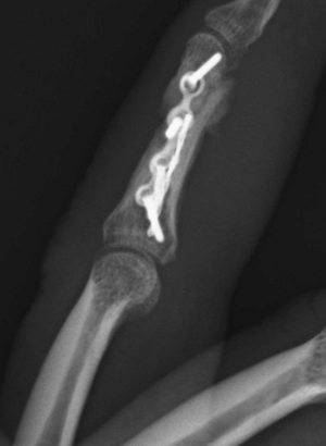open fracture of the middle phalanx postop