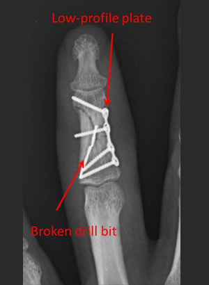 open fracture of the middle phalanx preop