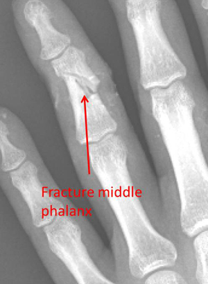 open fracture of the middle phalanx preop