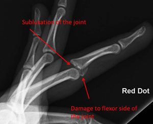 intraarticular fracture