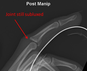 intraarticular fracture