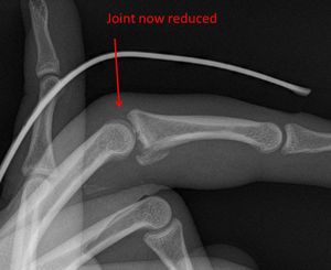 intraarticular fracture