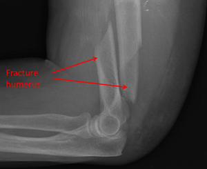 displaced fracture at the lower end of the humerus