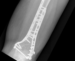 displaced fracture at the lower end of the humerus