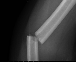 Humerus