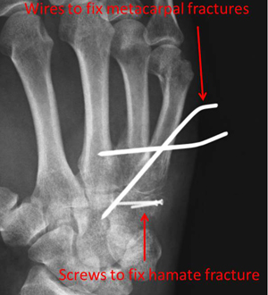 hamate fracture