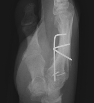 hamate fracture