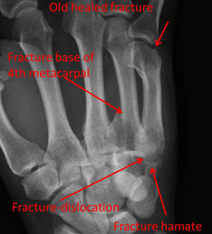 hamate fracture