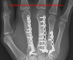 metacarpals of the index