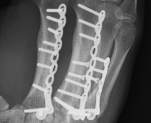 metacarpals of the index