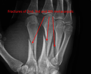 metacarpals of the index