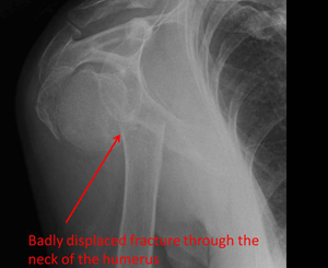 displaced fracture