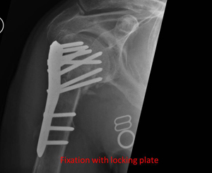 displaced fracture