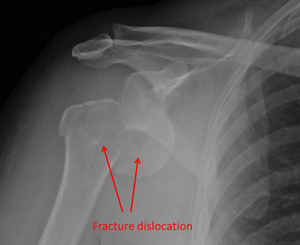 fracture-dislocation
