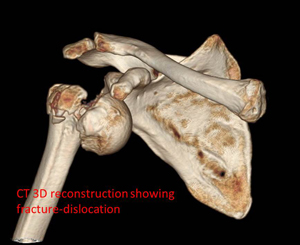 fracture-dislocation