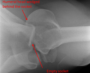 locked posterior fracture dislocation