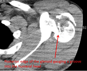 locked posterior fracture dislocation