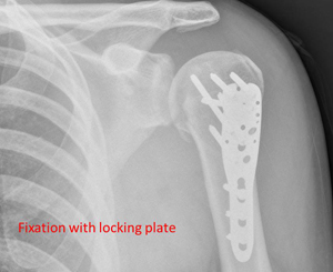 locked posterior fracture dislocation