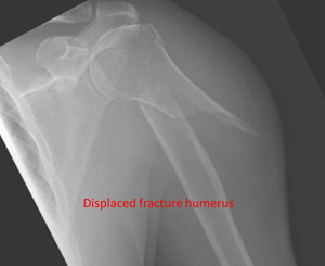 proximal humerus