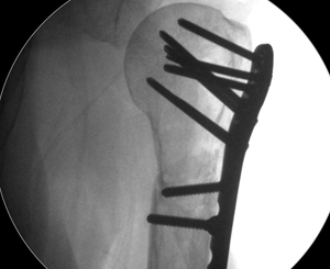 proximal humerus