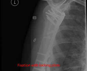 proximal humerus