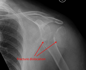 reverse shoulder replacement