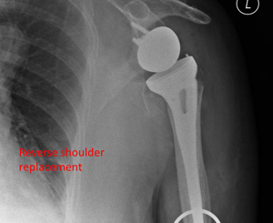 reverse shoulder replacement