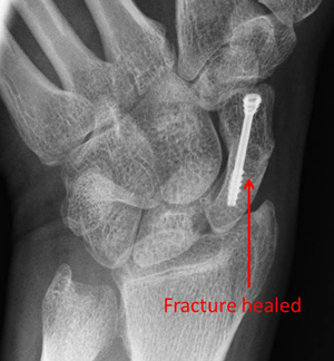 Percutaneous fixation