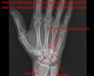 Unusual fracture dislocation