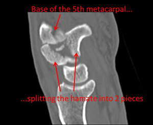 Unusual fracture dislocation