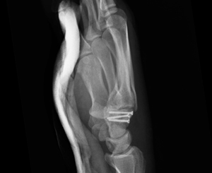 Unusual fracture dislocation